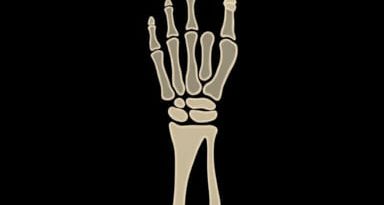 Displaced Distal Radius Fracture