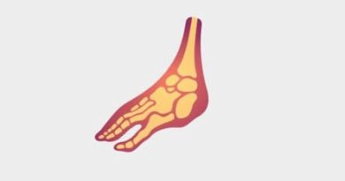 Etiology Of Rheumatoid Arthritis