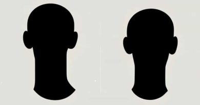 Neck Hump Before And After