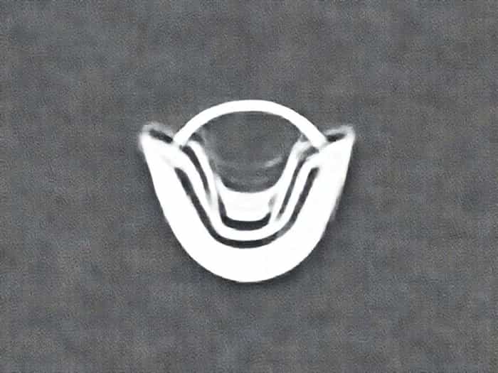 Visible Epiglottis In Adults