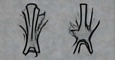 Give Two Examples Of Cartilaginous Joints