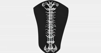X Ray Of Healed 5th Metatarsal Fracture