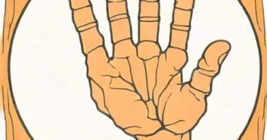Ulnar Focal Cortical Indentation