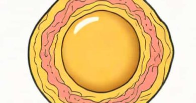 Yolk Sac Tumor Pathology Outlines
