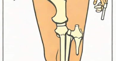 Neck Of Femur Fracture Treatment Without Surgery