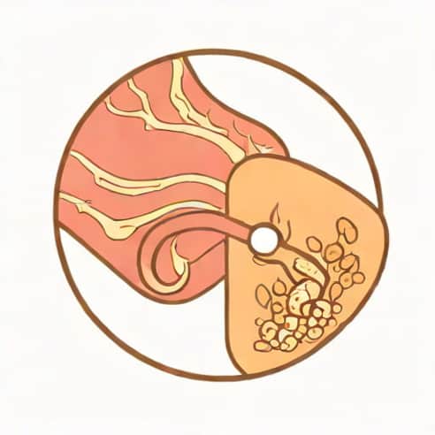 Ulcerative Rectosigmoiditis Without Complications